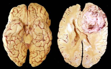 Həkim beyin xərçəngini bu metodla - tam sağaltdı