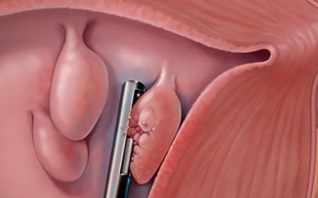 Menstruasiyada pozulmalar poliplərdən  ola bilər