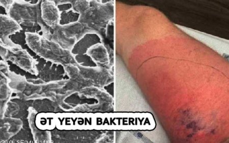 İnsanı 2 günə öldürən ət yeyən bakteriya sürətlə yayılır