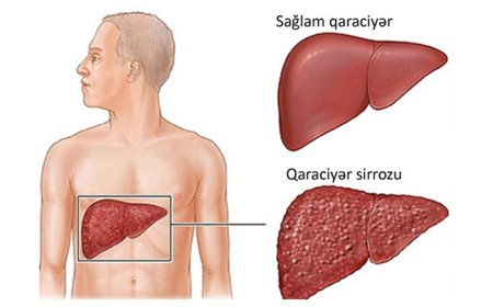 Serroz xəstəliyi  nədir?