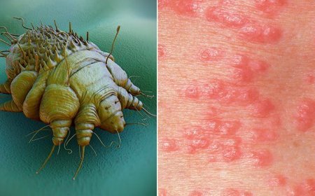 Qotur xəstəliyi nədir