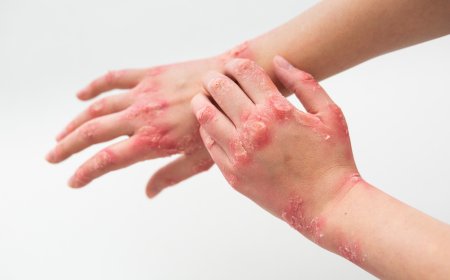 Eqzema xəstəliyi nədir?