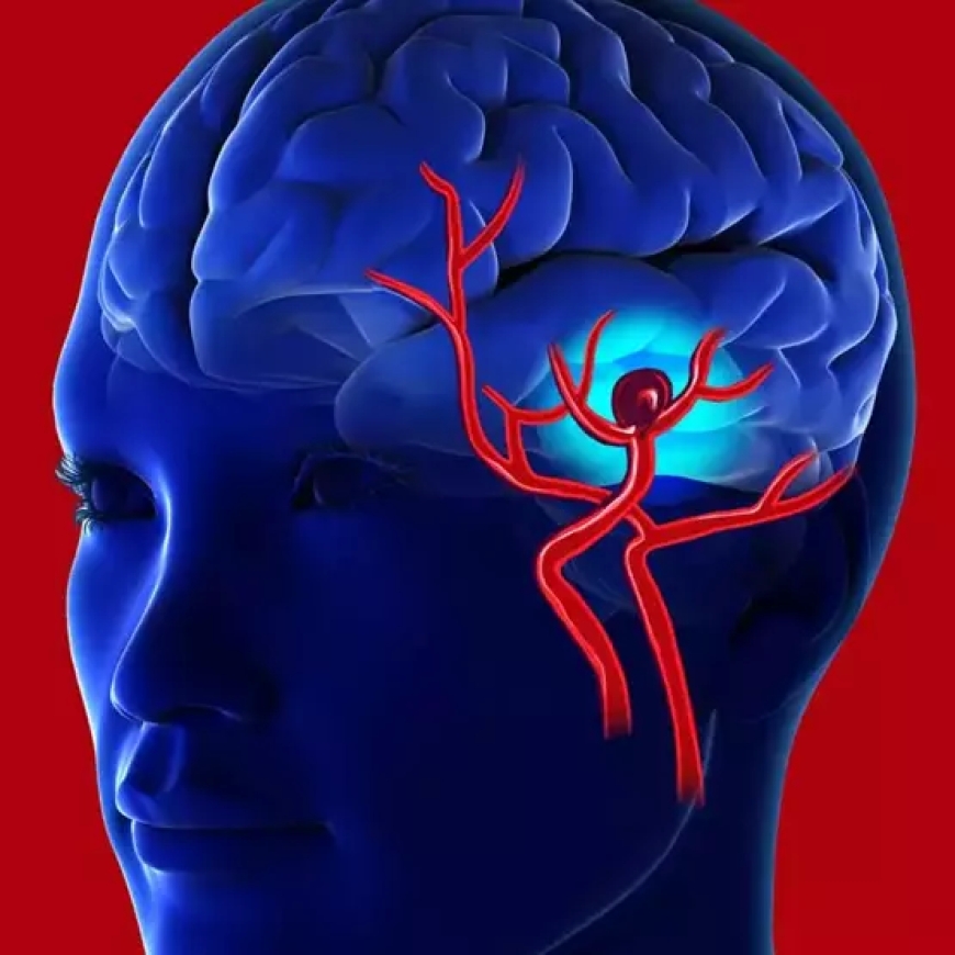 Beyin anevrizması nədir?