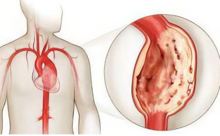 Ürək anevrizması nədir?