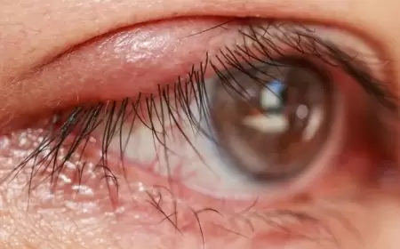 Gözdə itdirsəyi çıxıbsa - Müalicə metodları