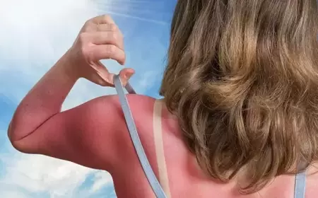 Günəş yanığına nə etməli