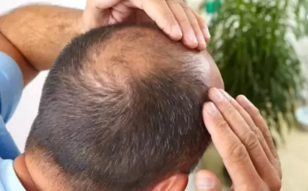 Keçəllikdən xilas edən YENİ ÜSUL