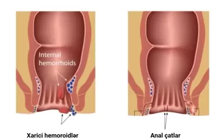 Bağırsaq  çatların çarəsi