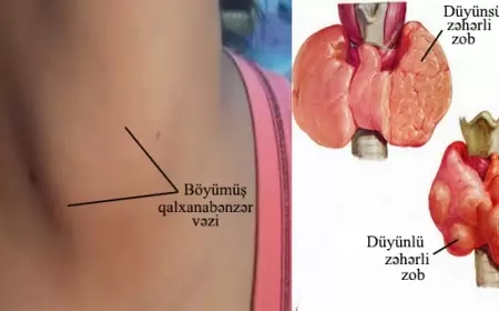 Zobun müalicə ÜSULLARI