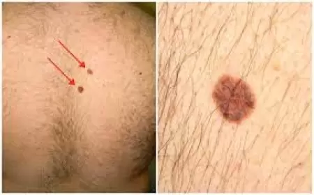 Bədəninizdəki xallar hansı halda qorxuludur?