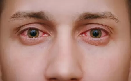 Qızarmış gözləri çay dəmləməsi ilə yumaq olar?