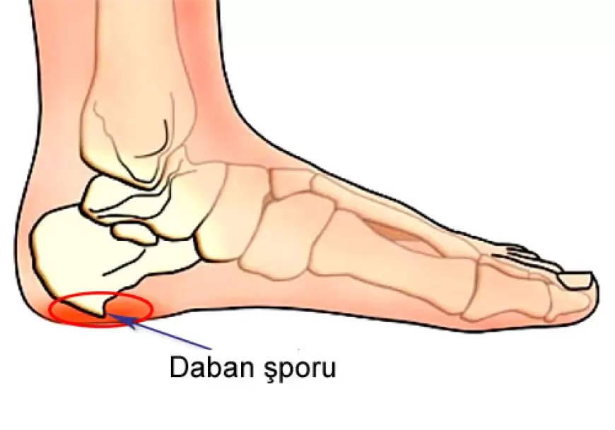 Dabanda ağrıların səbəbi - daban şporları