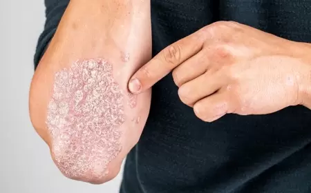Alimlər psoriazın potensial səbəbini tapdılar