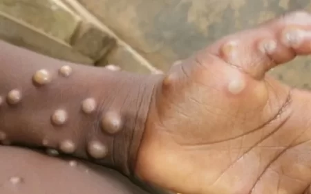 Daha iki ölkədə meymunçiçəyi aşkarlandı