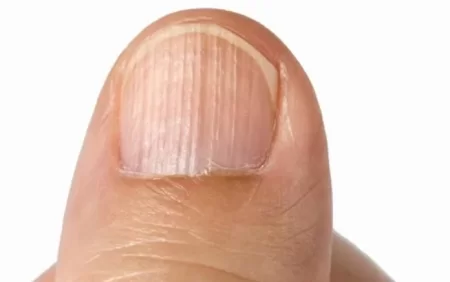 Dırnaqlardakı şaquli xətlər nə deməkdir? - vitamin çatışmazlığı...