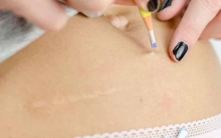 Qıl dönməsi nədir? - Əlamətləri, müalicə