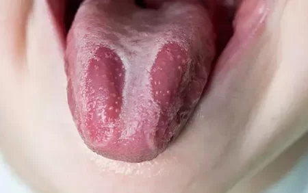 Dildə əmələ gələn ərp hansı xəstəliyin əlamətidir?