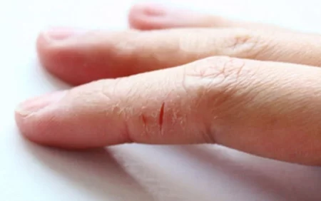 Əllərdə çatlar - SƏBƏBLƏR VƏ ÇARƏLƏR