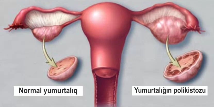 Yumurtalıqların polikistoz sindromu haqqında məlumat