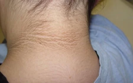 Boyunda qara ləkələr bu xəstəliklərin ƏLAMƏTİDİR