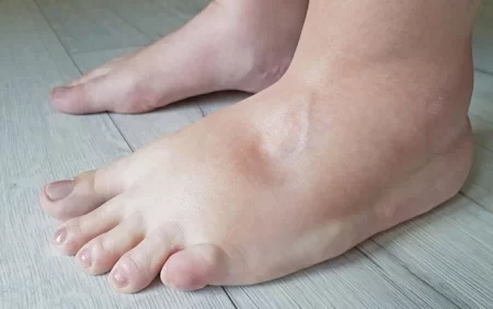 Əl-ayaqda şişkinlik ürəkdən, yoxsa böyrəkdəndir?