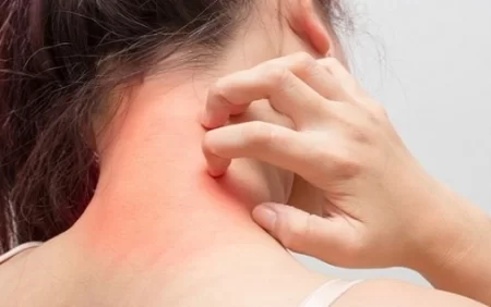 Dəri xəstəlikləri və qaşınma bitdən ola bilər?