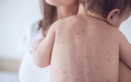 Qızılca (Xəstəlik)