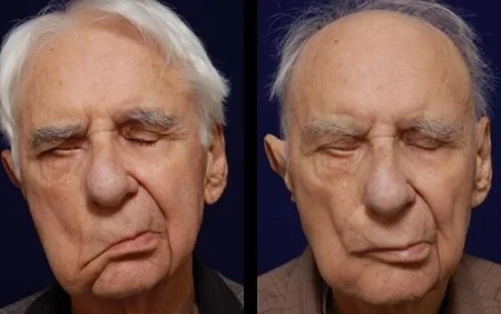 Üz sinirinin travmalarından sonra mimikanı bərpa etmək üsulu tapıldı