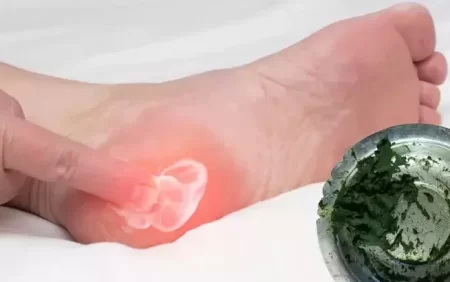 Daban tikanını (mahmız) müalicə etmək üçün nənələrimizin məhşur resepti