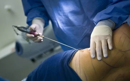 Daha bir xanım liposaksiyanın qurbanı oldu - MÜƏMMALI ÖLÜM