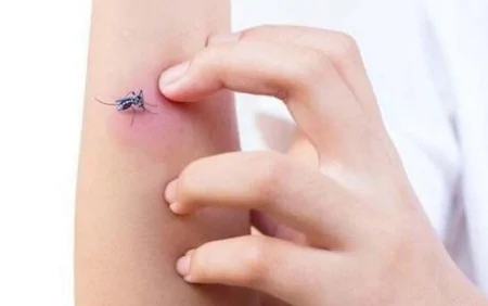 Həşərat dişləmələrinin yerlərini qaşımaq faydalı imiş