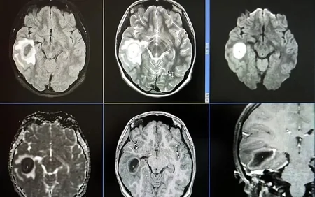 Qulağı ağrayan məktəbli qızın BEYNİNDƏ...