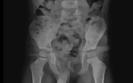 5 yaşlı uşağın orqanından çıxanlar həkimləri heyrətə gətirdi - FOTO