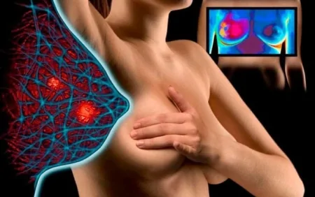 Qadınlarda “limon qabığı” effekti – Xərçəngdən xəbər verə bilər?