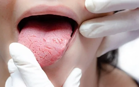 Dildəki çatlaqlar ədən xəbər verir?