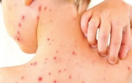 Qızılca epidemiyası yayılır: Xəstə sayı 1000-ə yaxınlaşır