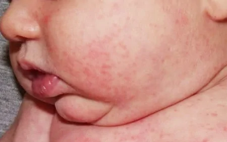 Tərləmək uşaqlarda səpki yarada bilər