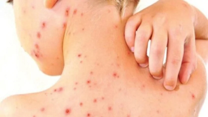 Qızılca epidemiyası yayılır: Xəstə sayı 1000-ə yaxınlaşır