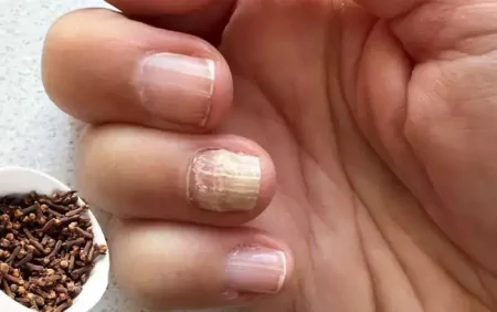 Dırnaq göbələyinə iki sadə məhsulla TƏBİİ ÇARƏ