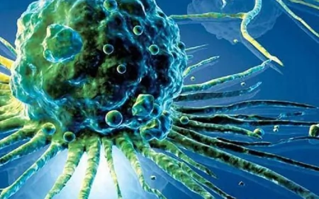 Mədə Xərçənginin əsas səbəbi tapıldı