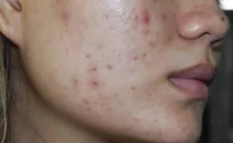 Bu qidalar üzdə sızanaq yaradır - Açıqlama