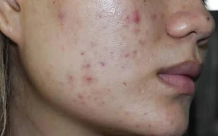 Bu qidalar üzdə sızanaq yaradır - Açıqlama